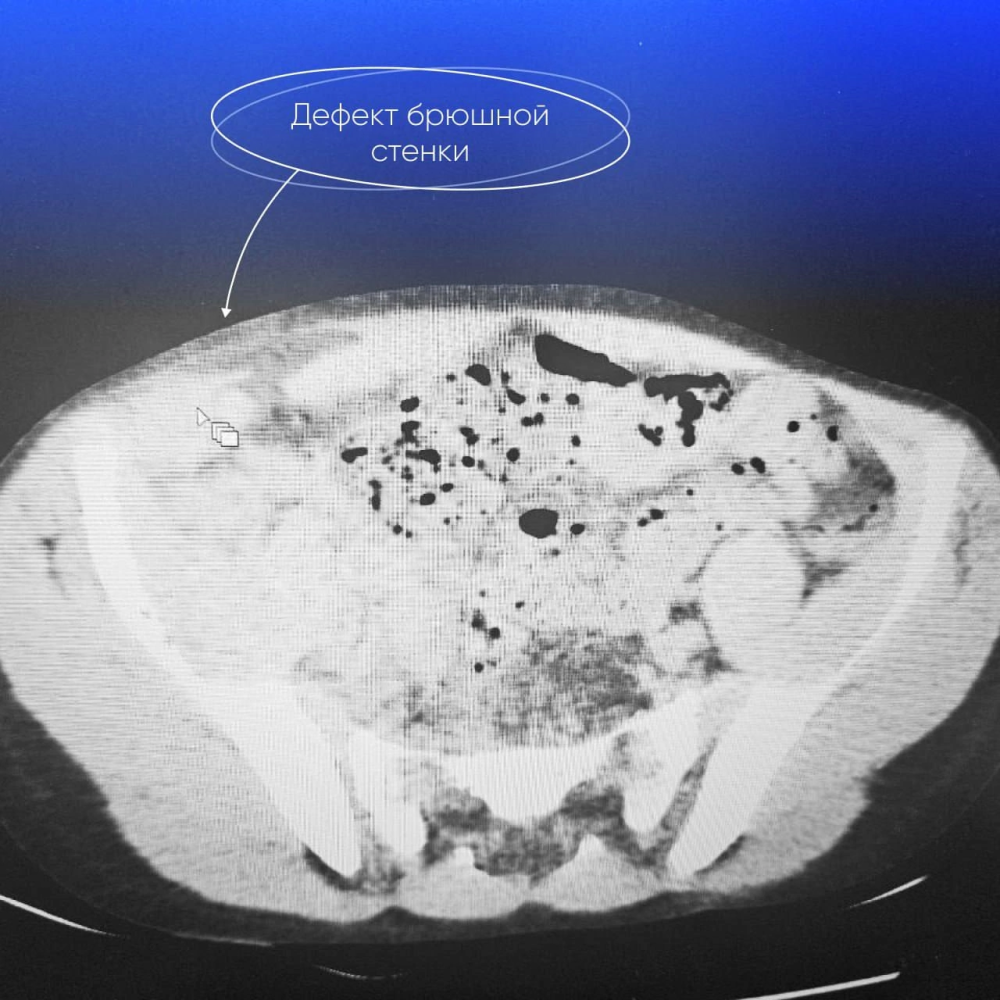    Врачи Югорска прооперировали 10-летнего мальчика с редкой травмой после падения на велосипеде