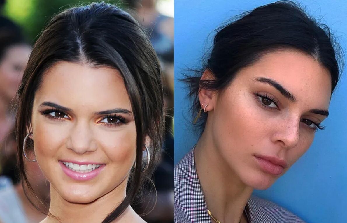 Кендалл Дженнер до и после подтяжки