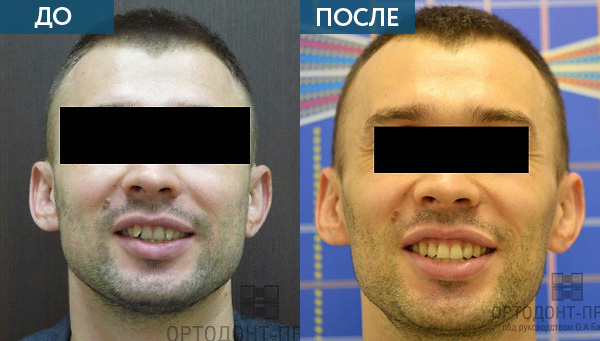 Глубокий прикус лицо до и после