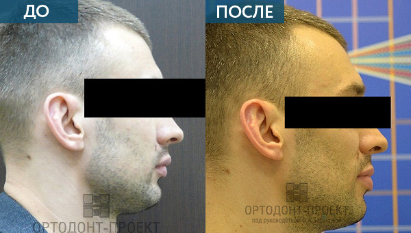 Глубокий прикус исправление ДО и ПОСЛЕ