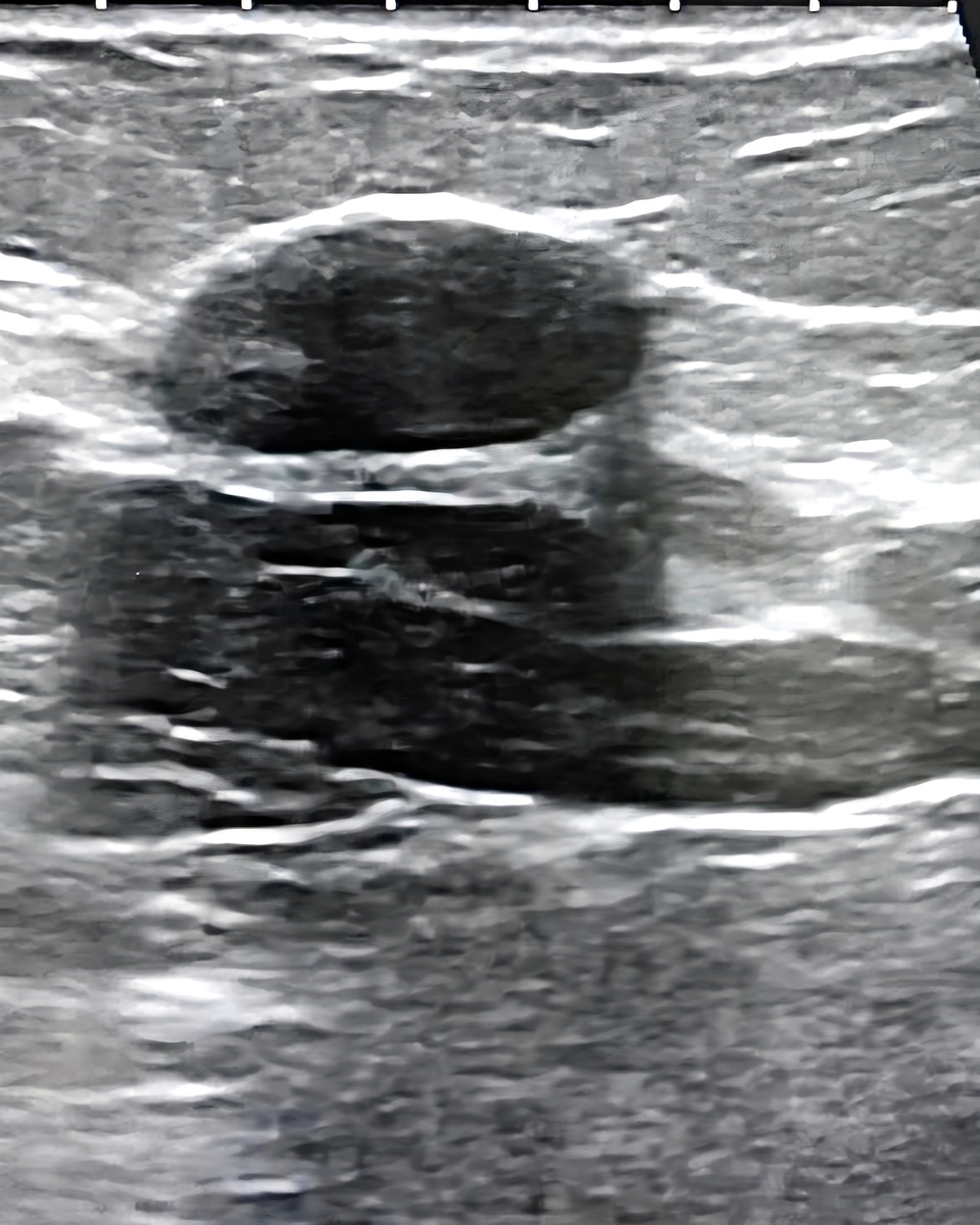 Так выглядит на УЗИ