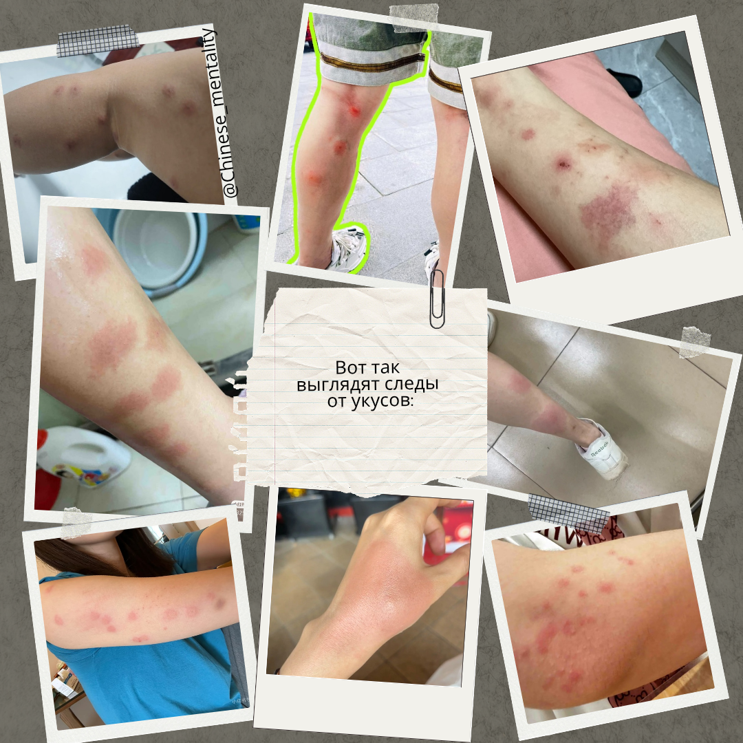 Так выглядят следы укусов