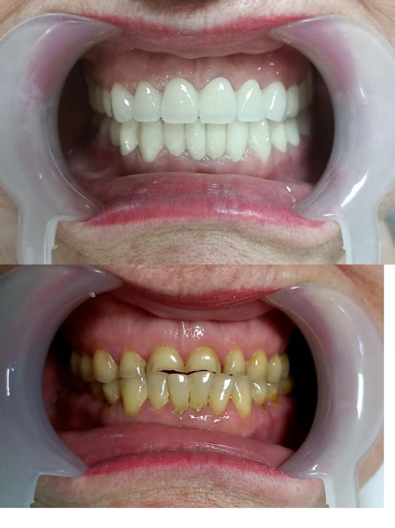 Было проведено лечение, установлены коронки из диоксида циркония