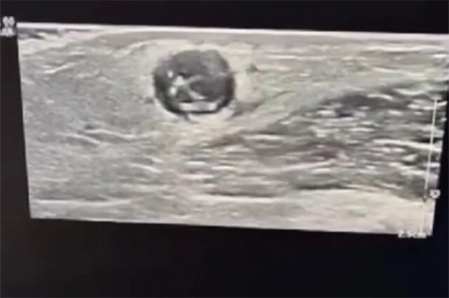    После осмотра врач сделал пострадавшей УЗИ и выяснил, что у женщины на плече образовалась киста, которая могла быть вызвана паразитической инфекцией. Фото: Пресс-служба Департамента здравоохранения города Москвы