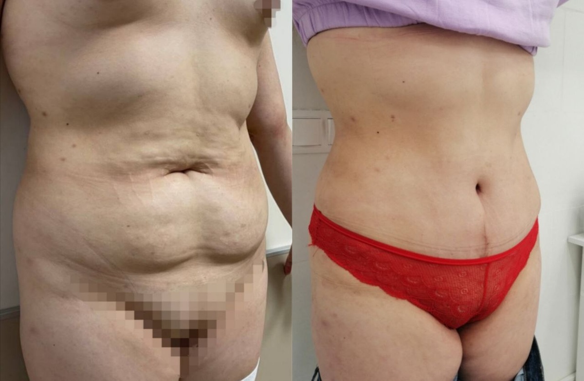 Результат после операции пластического хирурга Фролова Е. В.