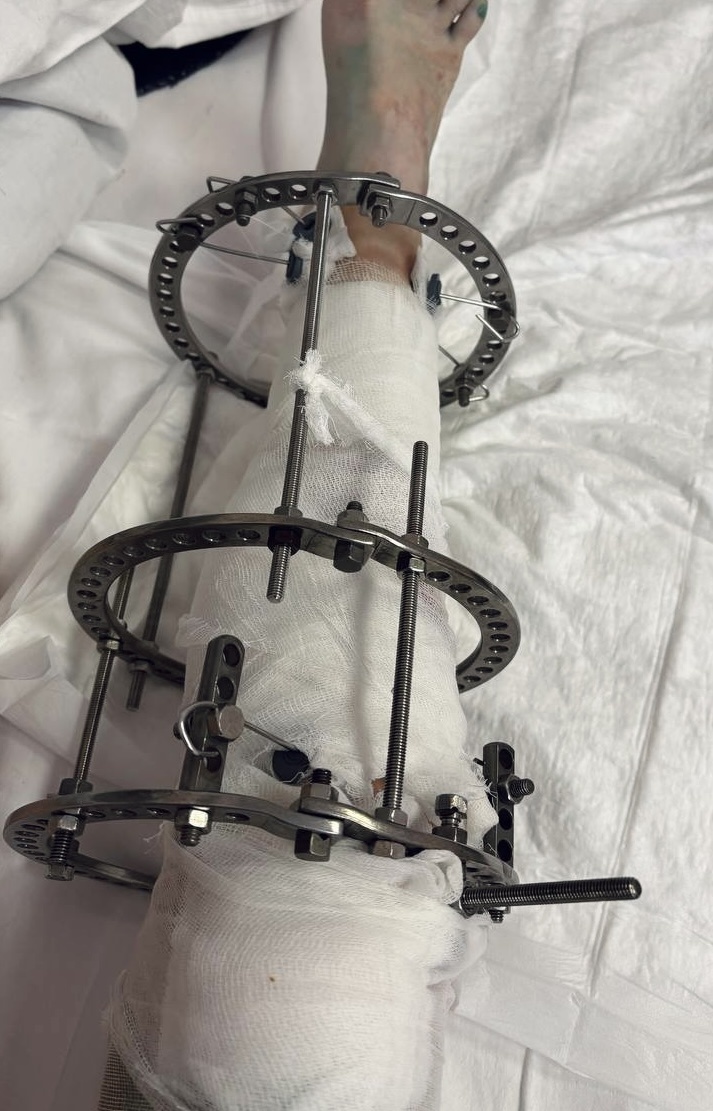 Аппарат Илизарова. Первый день после операции.