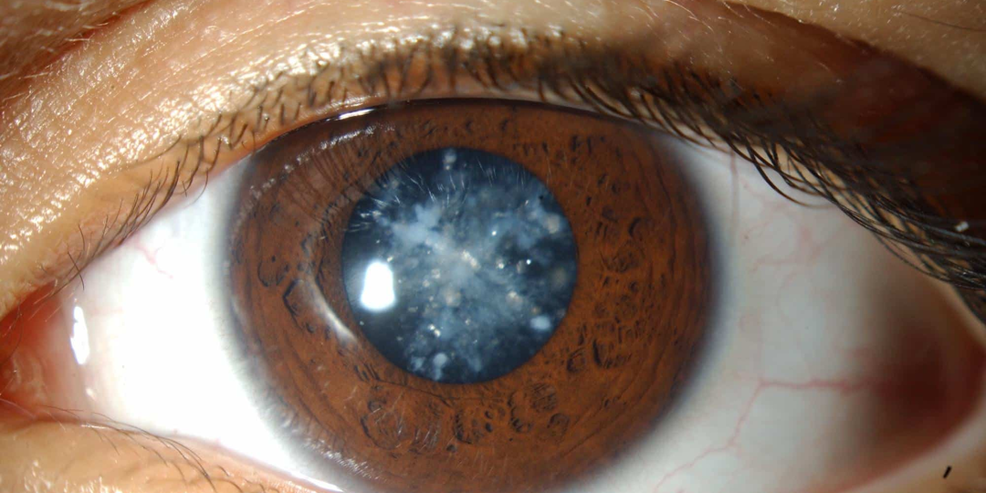 Катаракта — не болезнь, а возрастная неизбежность? Почему после 50 лет хрусталик мутнеет у всех людей?