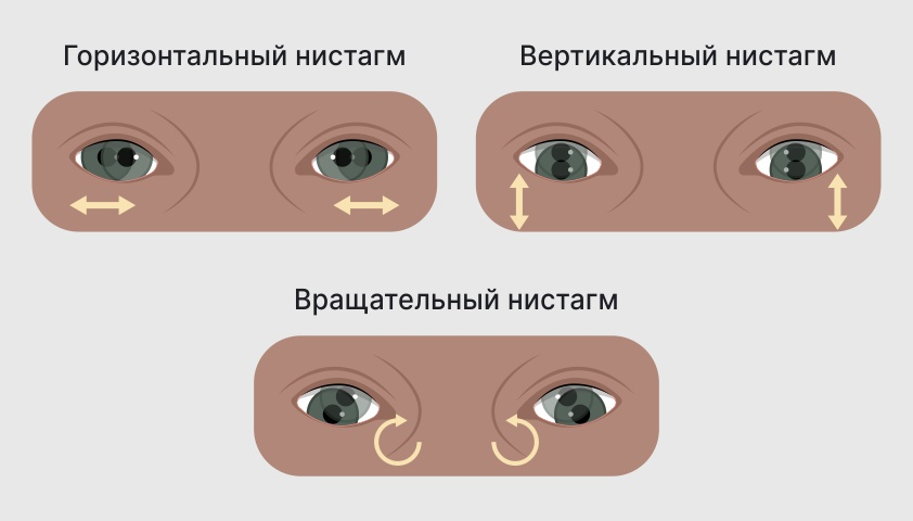 нистагм