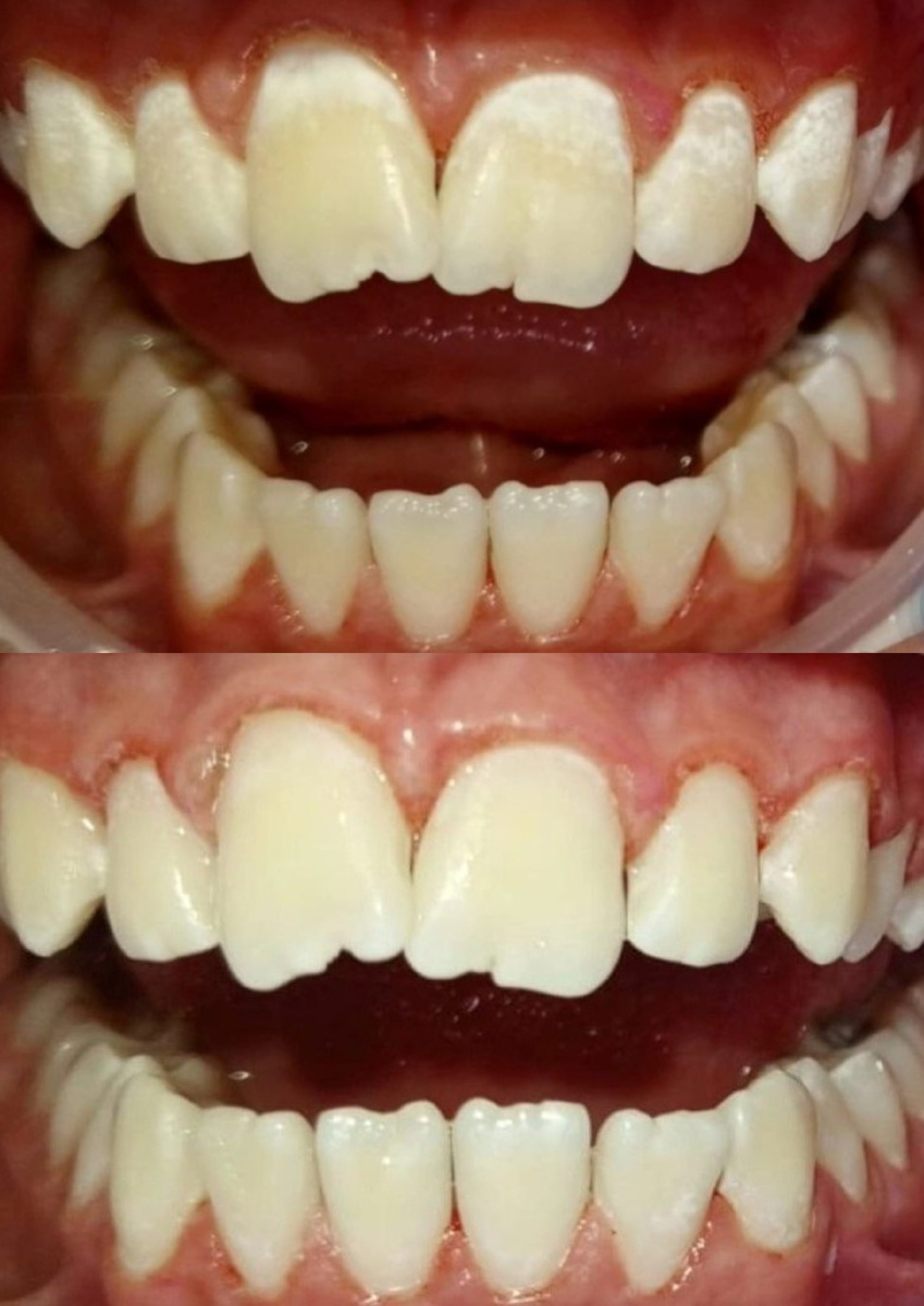 Лечение кариес до и после 