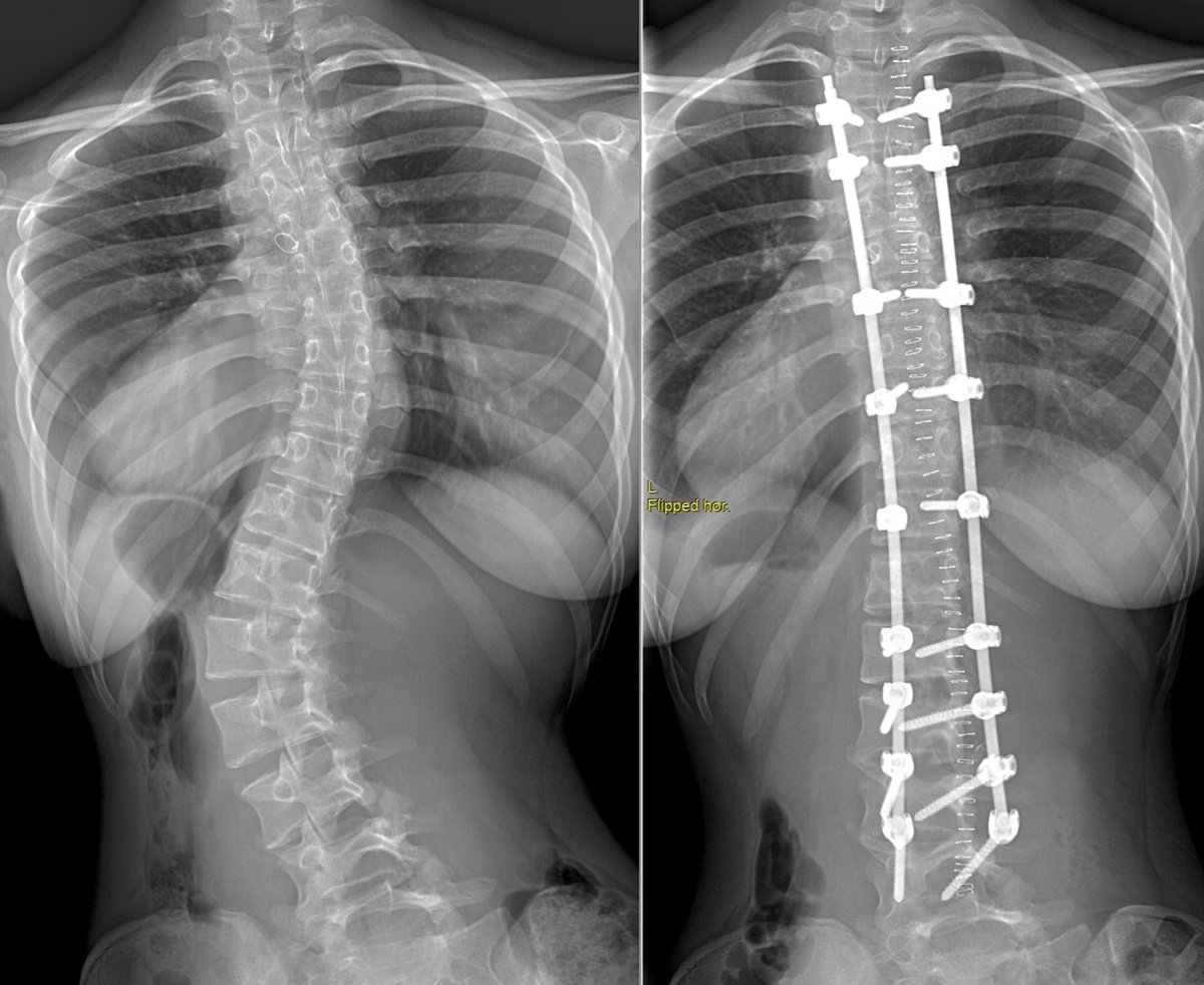 Хирургическое лечение сколиоза предполагает установку специальной металлоконструкции на всю жизнь