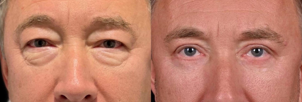 Блефаропластика верхних и нижних век и липофилинг нижних век. Фото до и после. Фото с сайта хирурга Д.Р. Гришкяна. Имеются противопоказания, требуется консультация специалиста