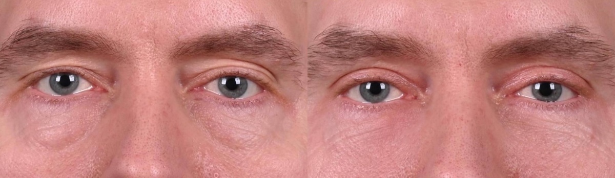 Блефаропластика верхних и трансконъюктивальная блефаропластика нижних век и липофилинг нижних век. Фото до и после. Фото с сайта хирурга Д.Р. Гришкяна. Имеются противопоказания, требуется консультация специалист