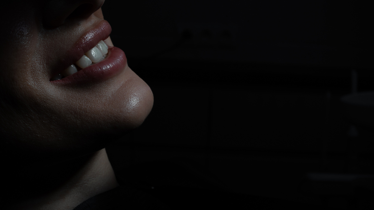 Какую ставят капу после снятия брекетов?