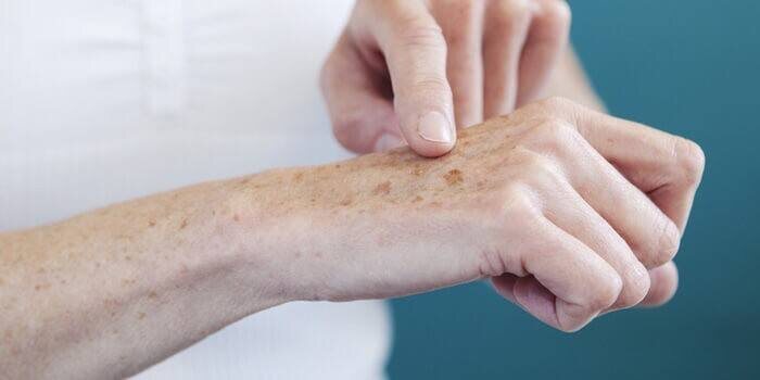 Темные пятна на руках: что говорят о вашем здоровье и как предотвратить их появление