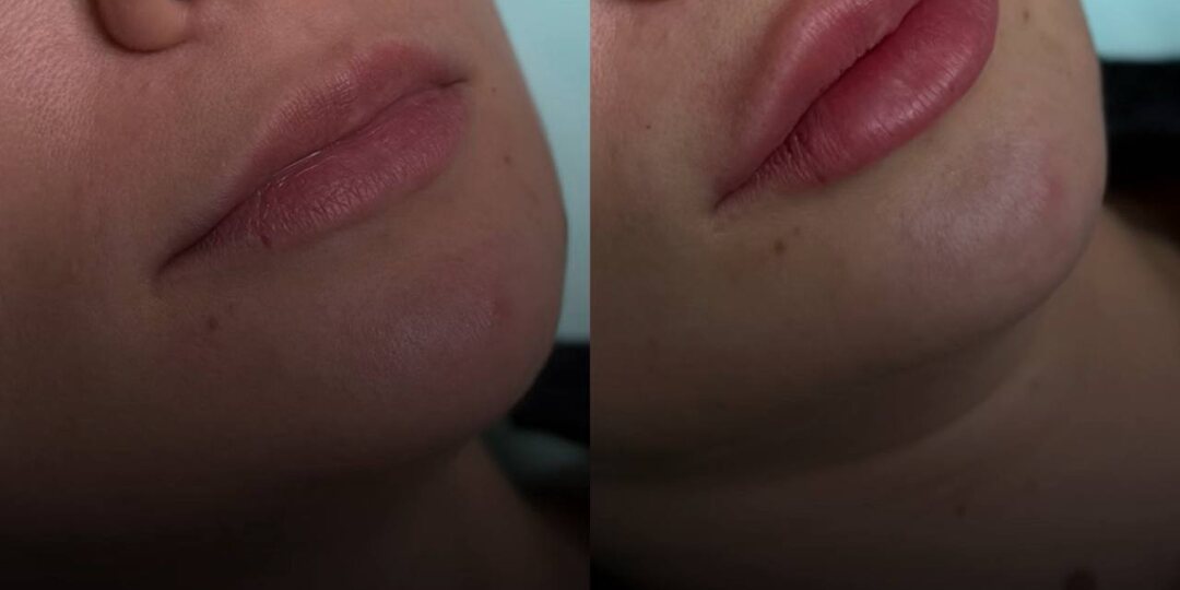 #губы до после