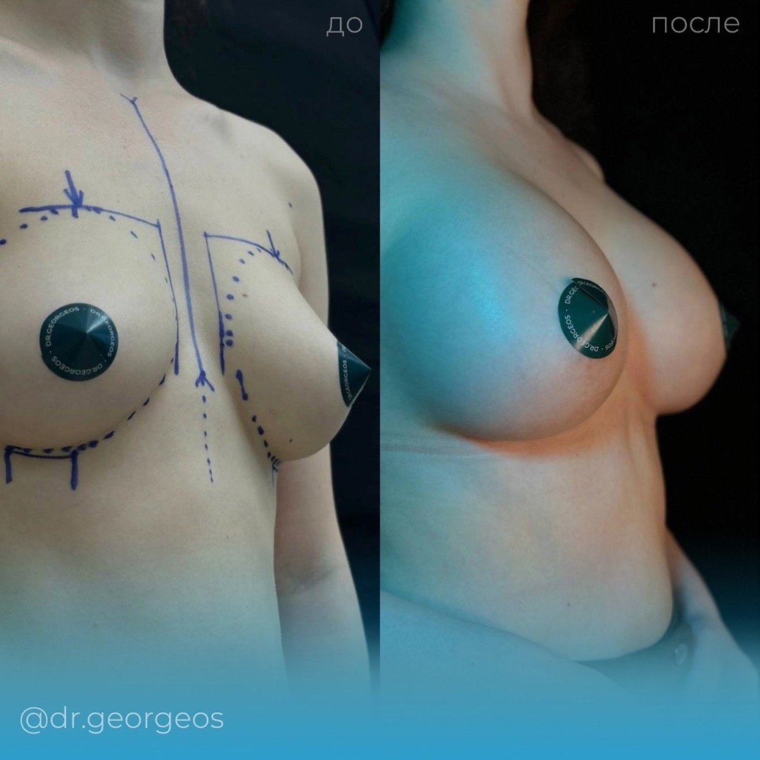 Увеличение груди импантами 330 мл