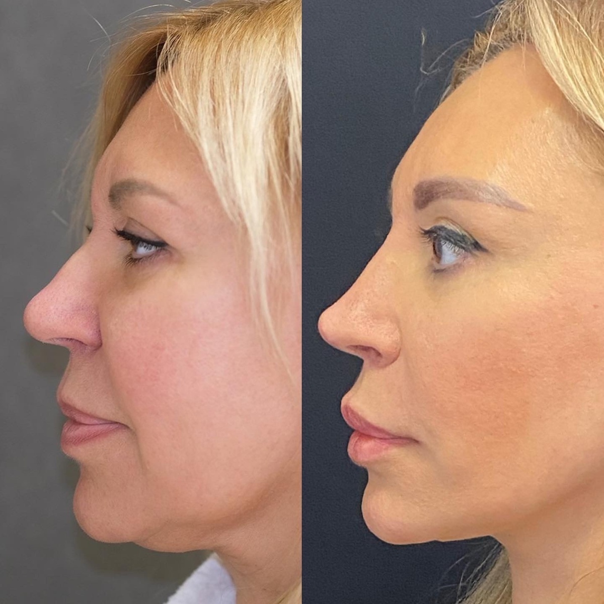 Результат подтяжкилица и ринопластики моей пациентки