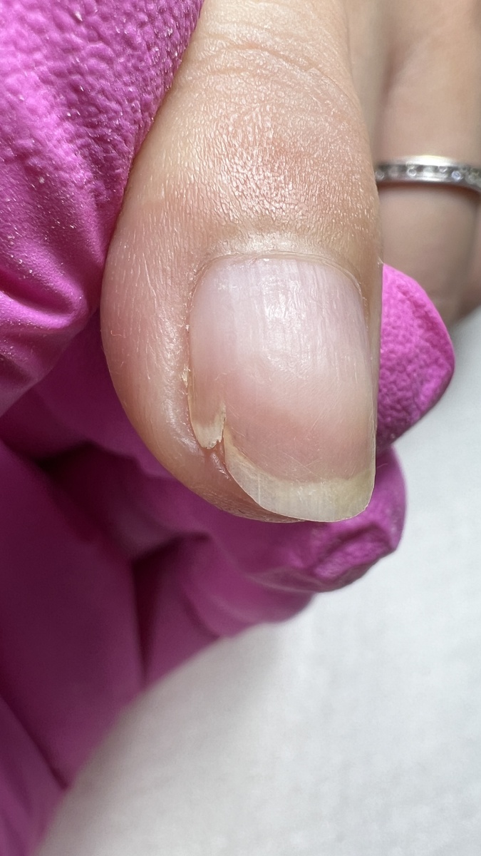 Ногти после агрессивной подготовки к наращиванию ногтей в салоне.