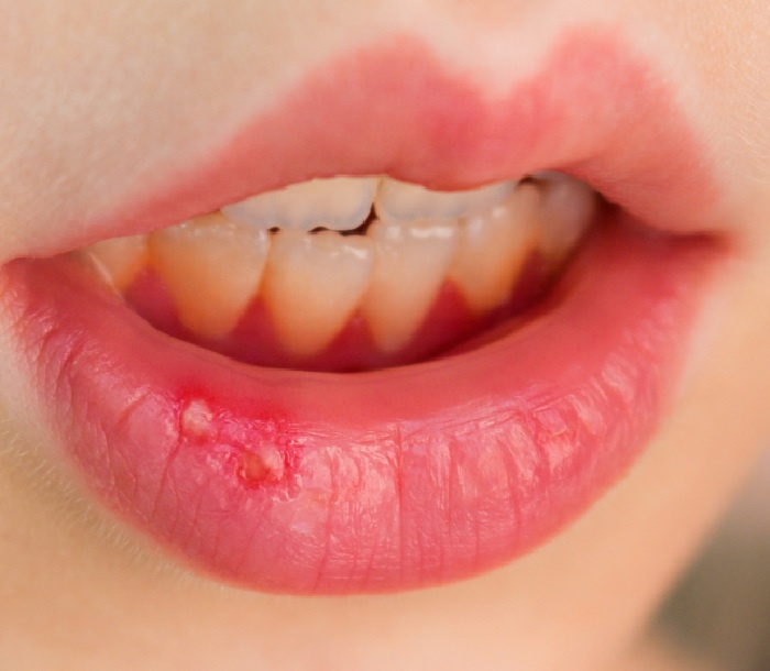 Как убрать запах изо рта