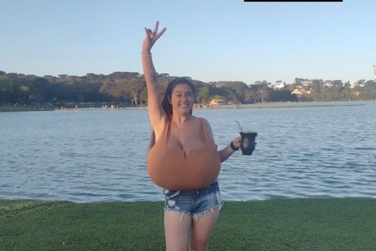     У девушки в Бразилии грудь росла на 750 грамм ежемесячно! Редкая болезнь