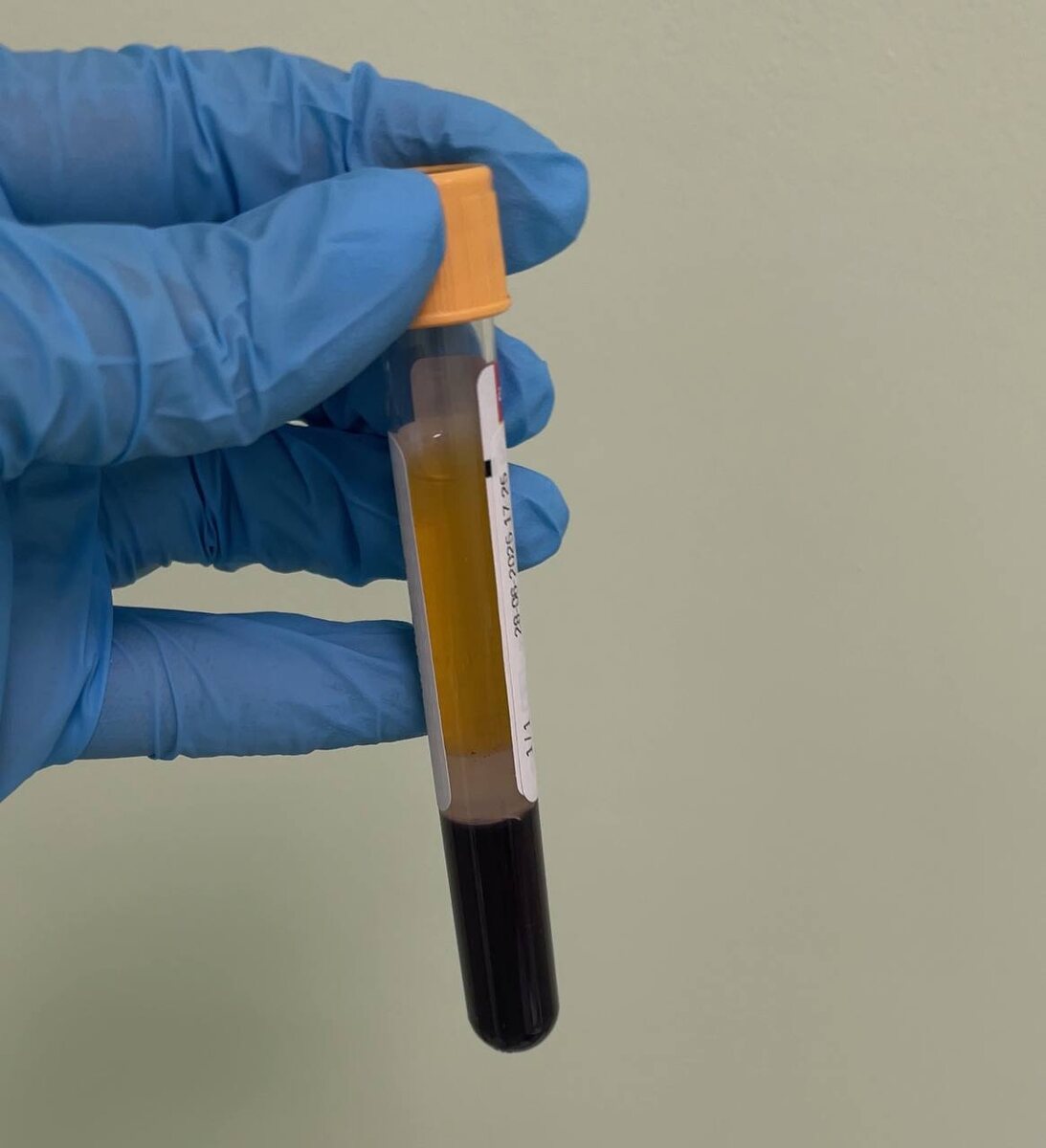 Сыворотка крови без хилеза