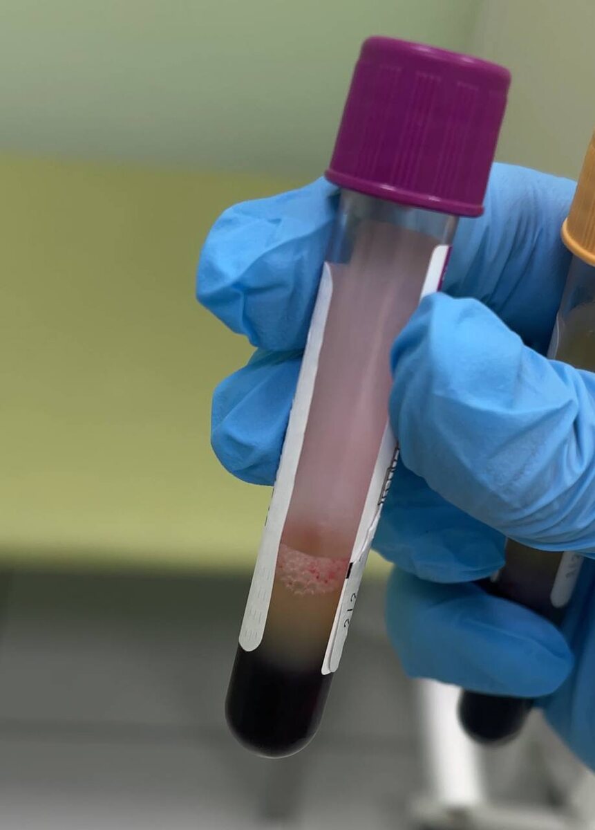 Сыворотка крови с хилезом