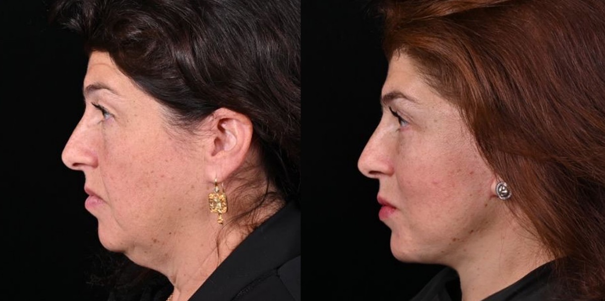 Выполнена подтяжка лица в модификации МАКС-лифт эдванс, липосакция и пластика шеи, объемно-омолаживающая пластика верхних век, липофилинг средней зоны лица, включая нижние веки. Фото до и после. Фото с сайта Д.Р. Гришкяна. Имеются противопоказания, требуется консультация специалистов