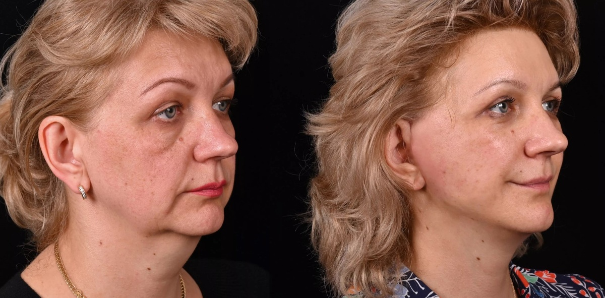 Пластика лица и шеи Macs-lift и липосакция шеи. Фото до и после. Фото с сайта хирурга Д.Р. Гришкяна. Имеются противопоказания, требуется консультация специалиста