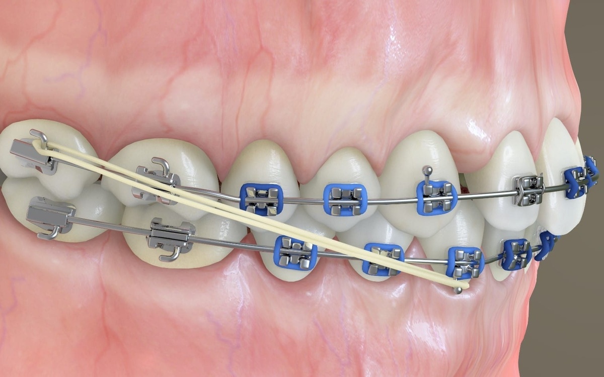 Эластики крепятся к брекетам с крючками, синие резинки - это эластичная лигатура