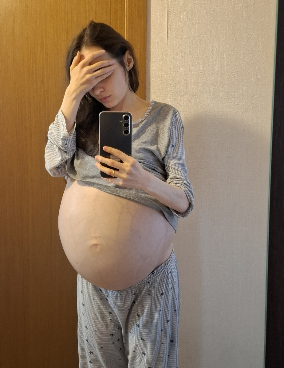 Асцит около 20 литров