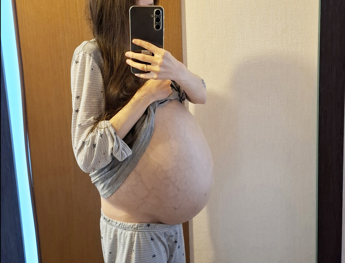 Вены и растяжки при асците