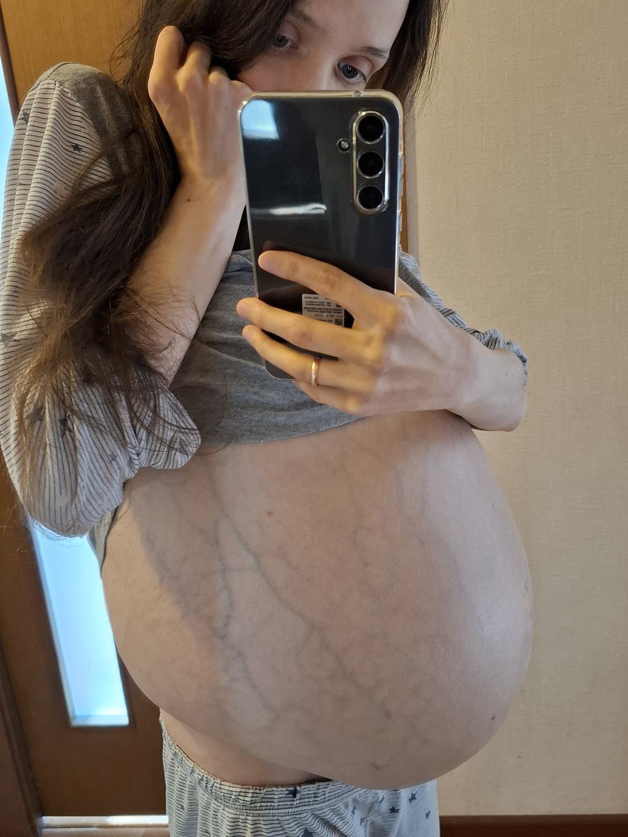 Асцитический живот