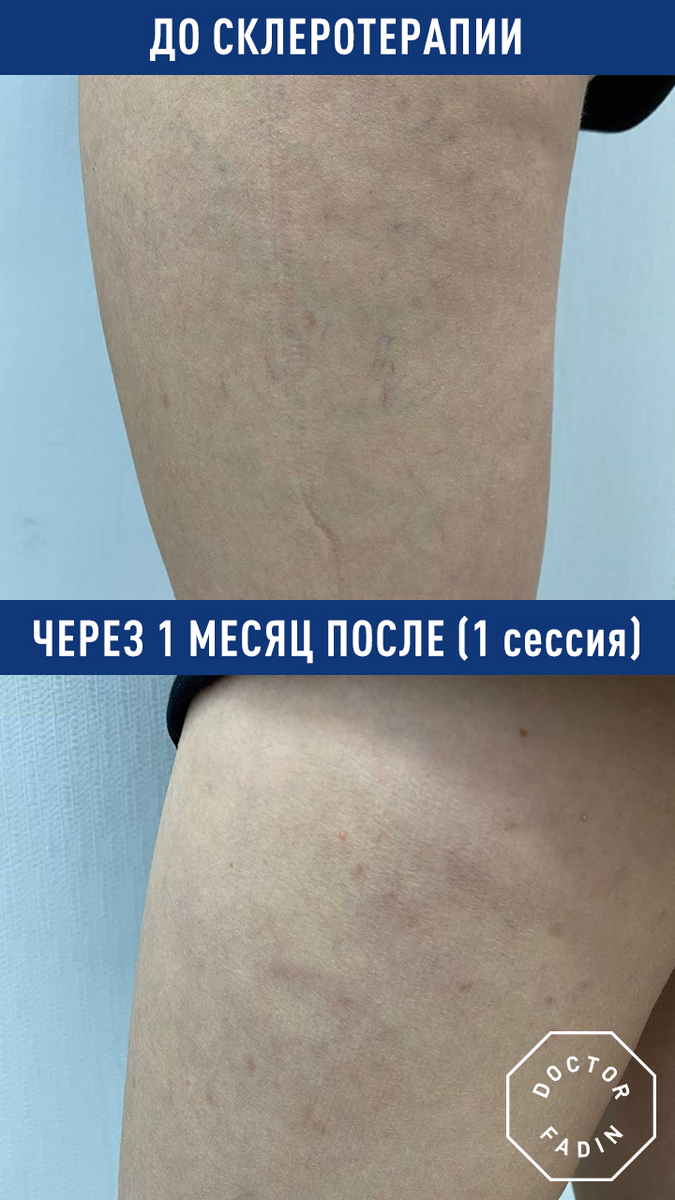 Склеротерапия без иллюзий: что действительно происходит с вашими ногами — рассказывает сосудистый хирург 