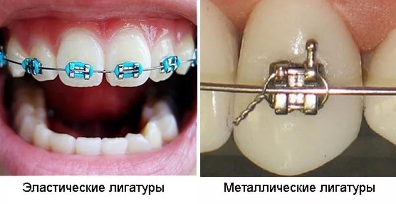Виды лигатур