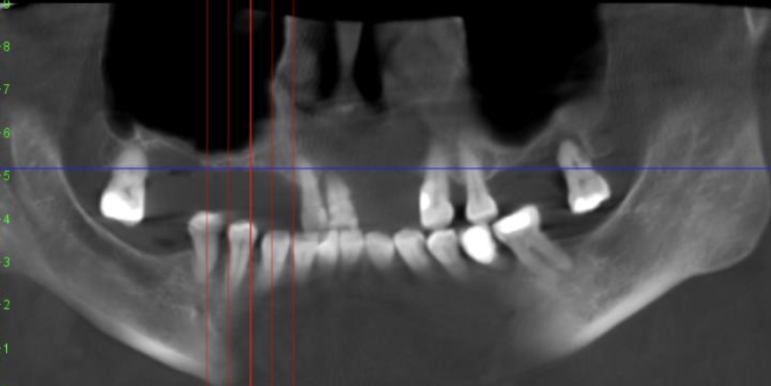 Когда не хватает кости для имплантации: что нужно знать о синус-лифтинге