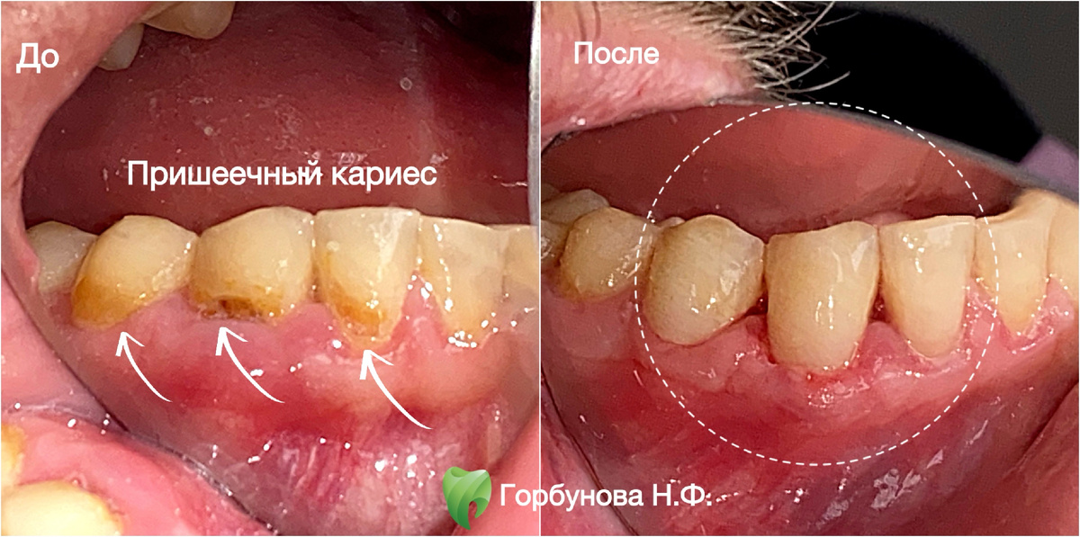 Лечение пришеечного кариеса