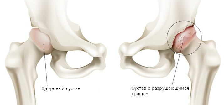 🦴 КОКСАРТРОЗ: РУКОВОДСТВО ДЛЯ ПОБЕДЫ НАД БОЛЕЗНЬЮ!