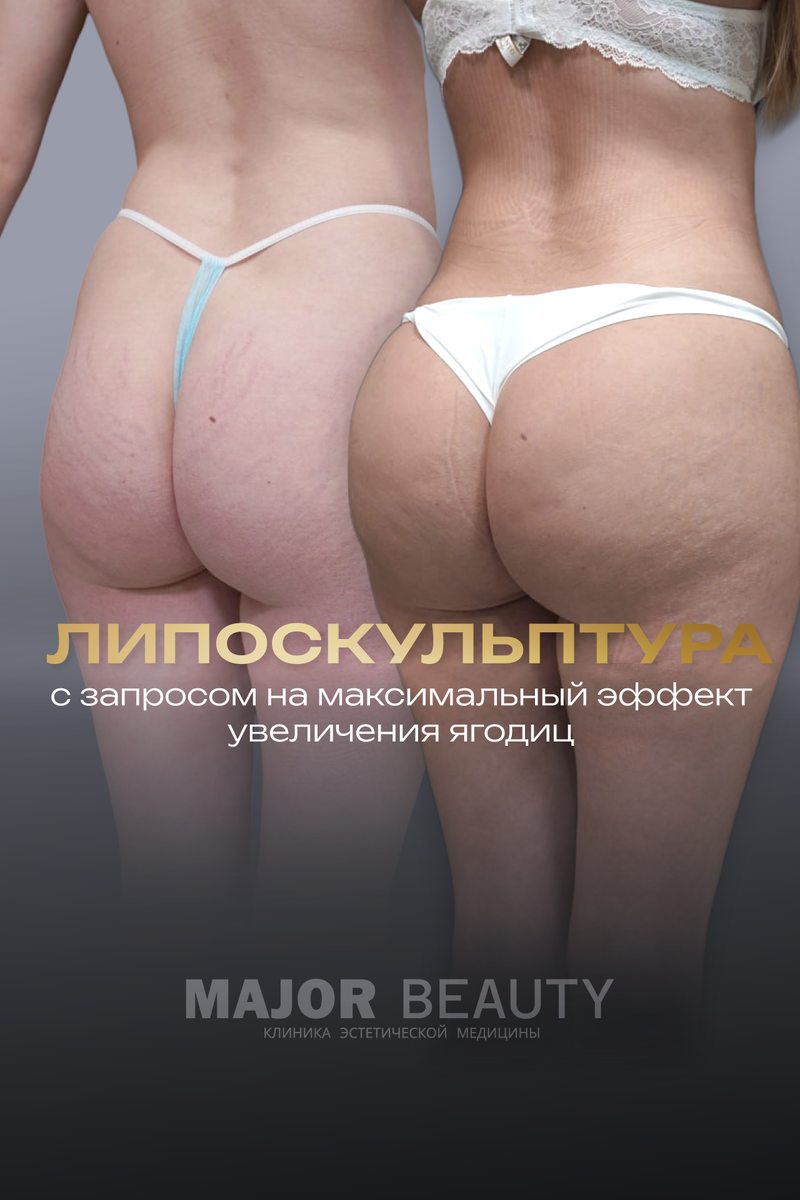 Увеличение ягодиц собственным жиром 