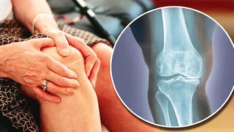 Простыми словами: как защитить суставы и остановить артроз после 40 лет