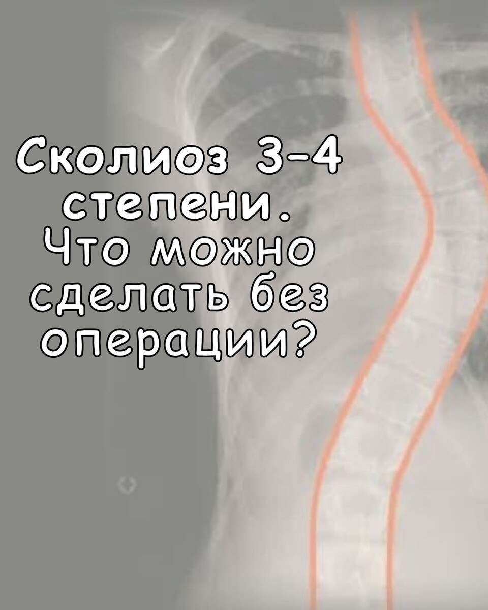 Сколиоз 3–4 степени. Что можно сделать без операции?