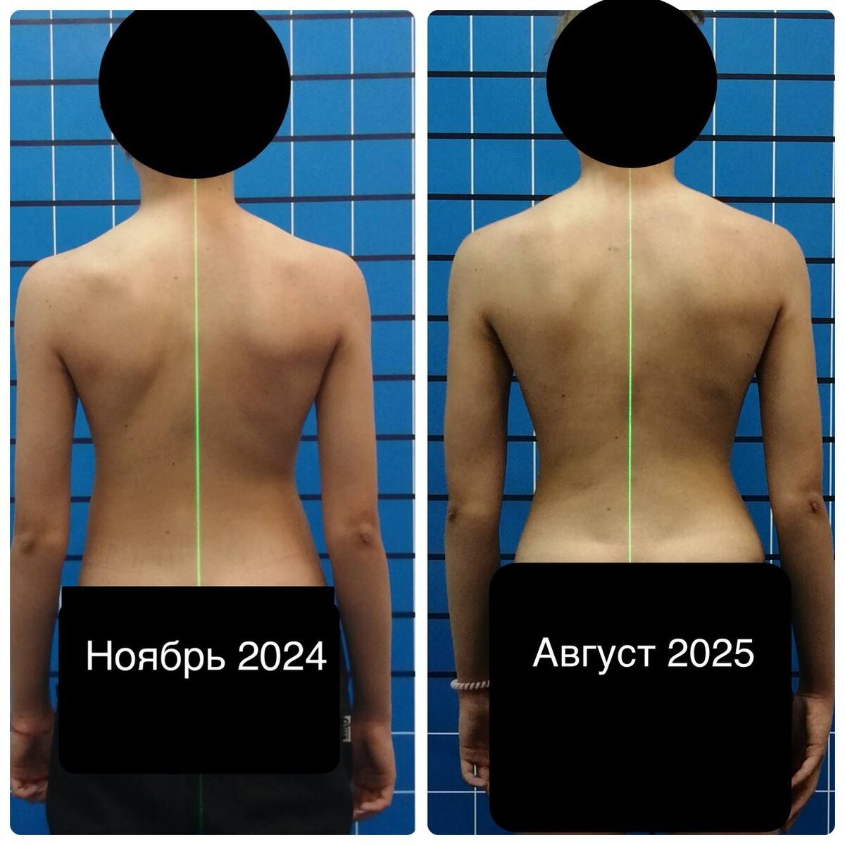 Результаты работы с девочкой 2011 года рождения. Корсет, индивидуальная работа со специалистом нашего Центра, двукратное участие в Интенсивах по остановке прогрессирования сколиоза.