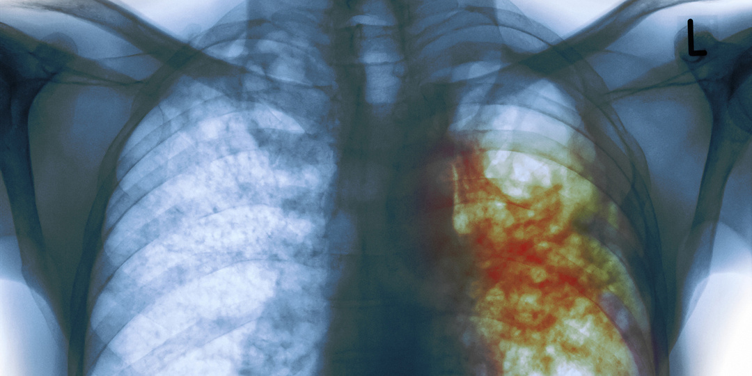 Туберкулез в России: успехи и вызовы нового времени