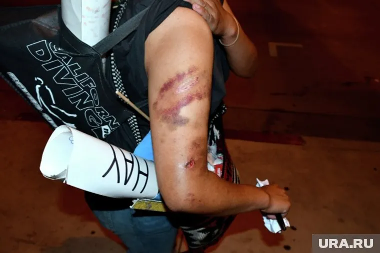 Самая распространенная причина появления гематомы — механическая травма в форме ушиба
Фото: Алексей Алексеев / РИА Новости