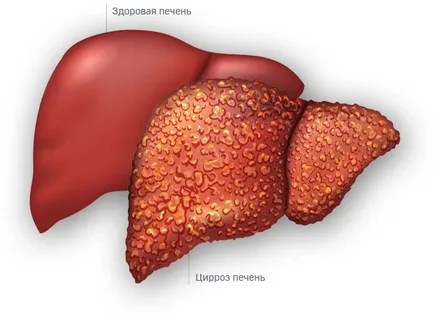 Цирроз печени – это не только алкоголь – врач назвала еще 4 причины повреждения