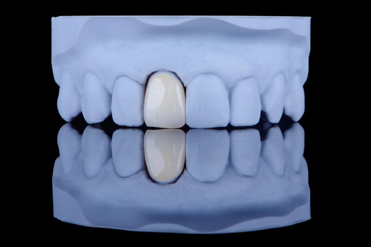 Керамические коронки рекомендуют при значительном разрушении зуба, когда пломба уже не справляется. 