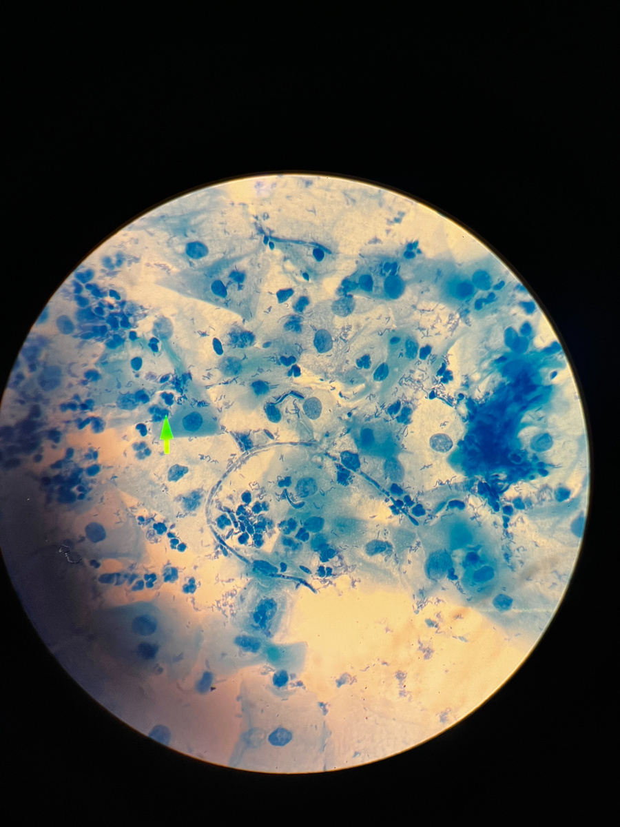 У пациентки жалобы на зуд, неприятные выделения. В мазке: лейкоцитоз, псевдомицелий и дрожжевые клетки (кандидоз), парабазальные клетки. Заключение: кандидозный вульвовагинит.