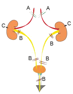 На рисунке: А — преренальная почечная недостаточность; Б — постренальная почечная недостаточность; В — ренальная почечная недостаточность.