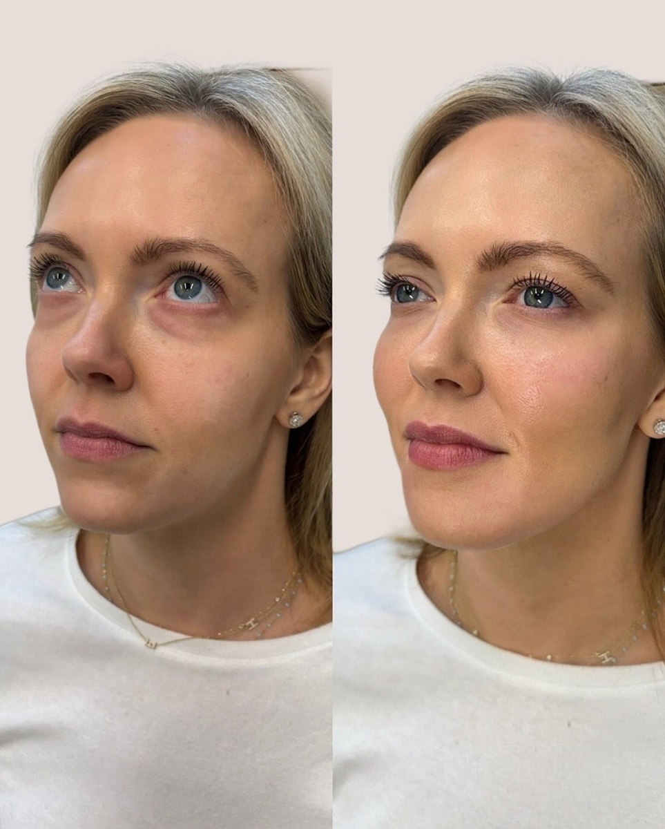 До / после коррекции носослезной борозды и биоревитализации 