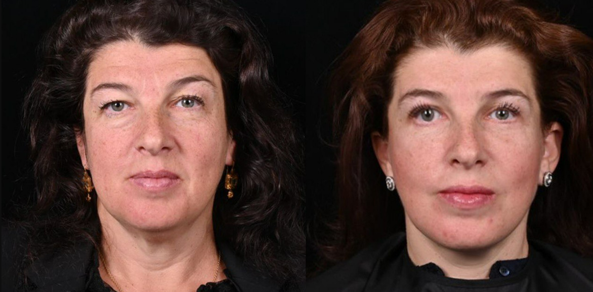 Комплекс омолаживающих операций, таких как подтяжка лица в модификации МАКС лифт эдванс, липосакция и пластика шеи, объемно-омолаживающая пластика верхних век, липофилинг средней зоны лица, включая нижние веки. Фото до и после. Фото с сайта хирурга Д.Р. Гришкяна. Имеются противопоказания, требуется консультация специалиста