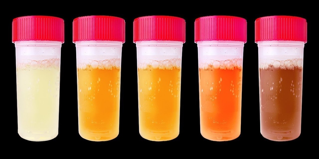 Что цвет мочи говорит о вашем здоровье